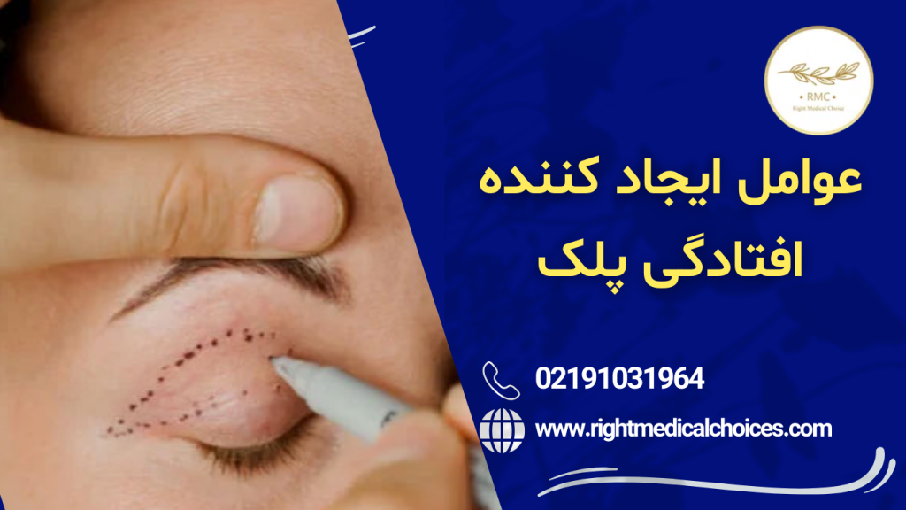 علائم پتوز پلک