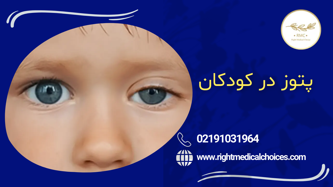 پتوز پلک در کودکان