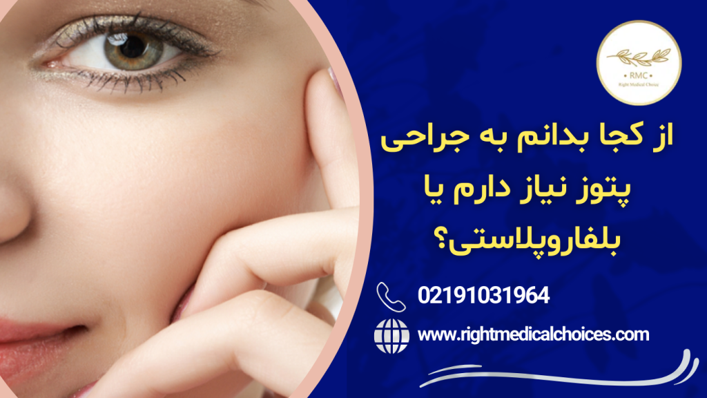پتوز یا بلفاروپلاستی