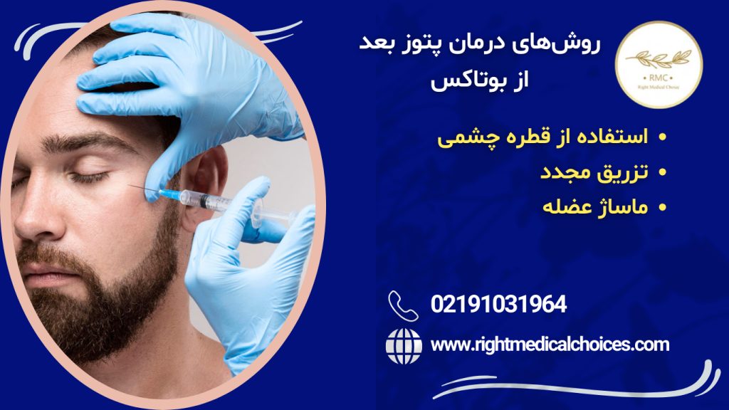 روش های درمان پتوز بعد از بوتاکس