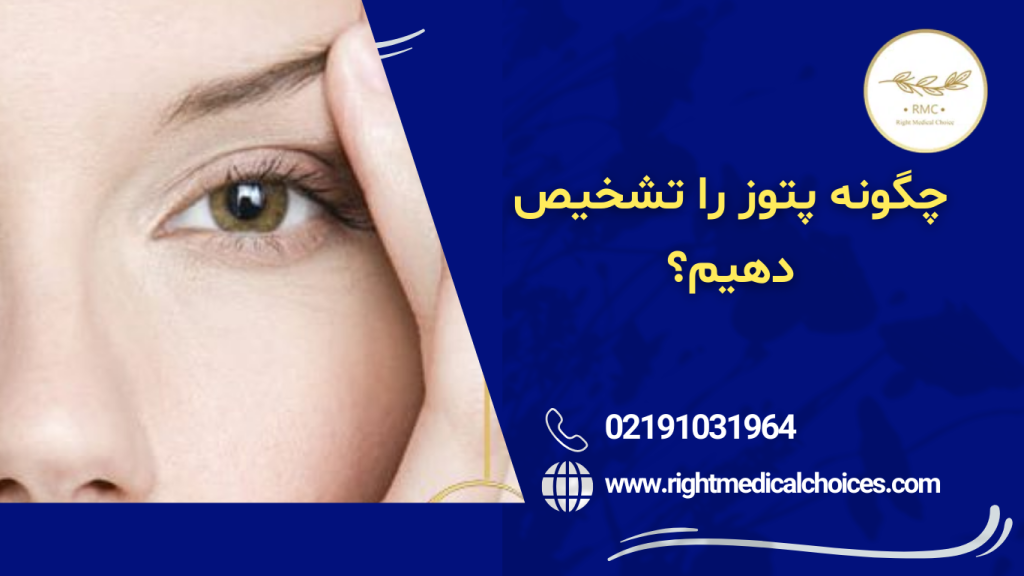 چگونه پتوز را تشخیص دهیم