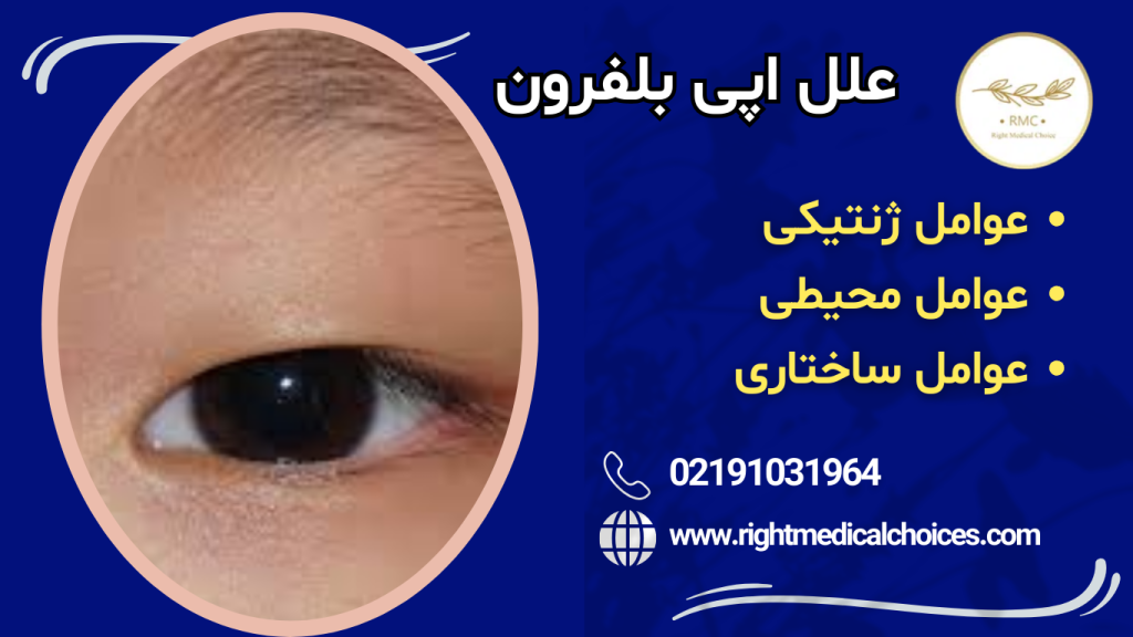 اپیبلفرون