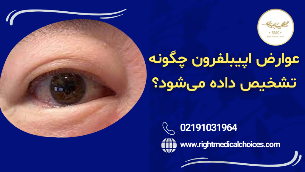 اپی بلفرون