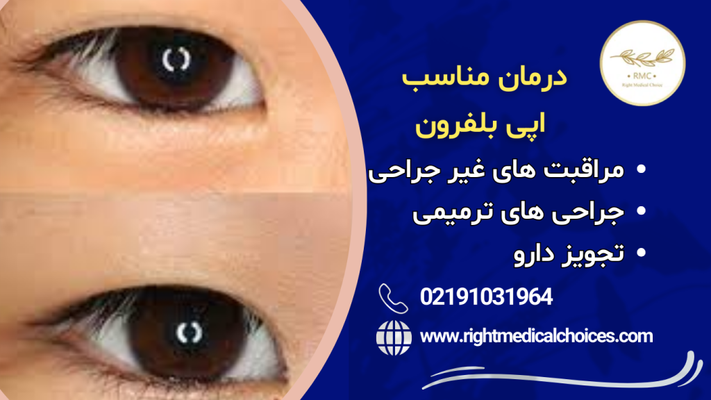 اپیبلفرون