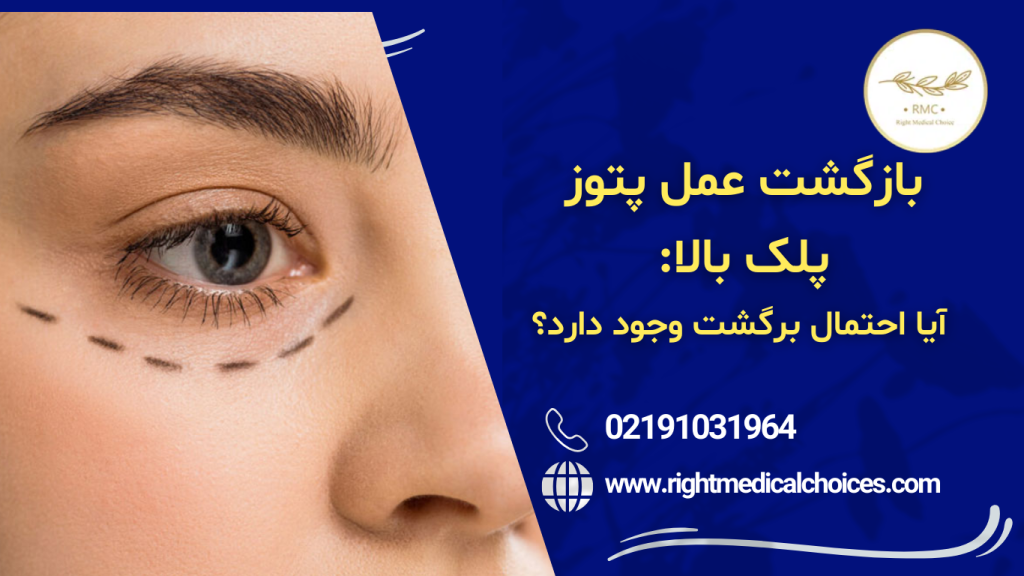 آیا احتمال برگشت پتوز وجود دارد؟