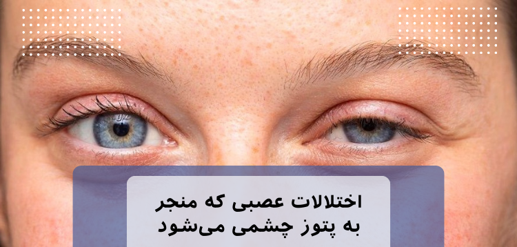 اختلالات عصبی و پتوز چشمی