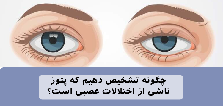 چگونه تشخیص دهیم پتوز چشمی از اختلال عصبی است