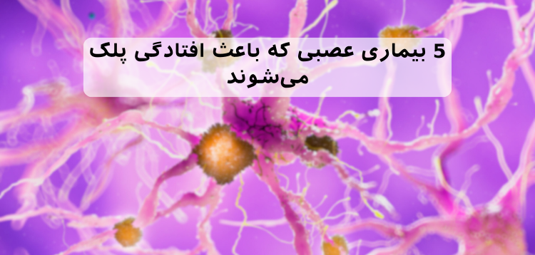 5 بیماری عصبی که منجر به اختلال پتوز چشمی می‌شود