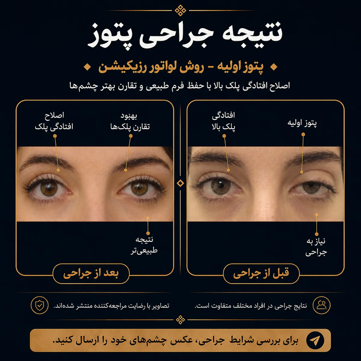 کیس پتوز اولیه؛ اصلاح موقعیت پلک با رویکرد لواتور