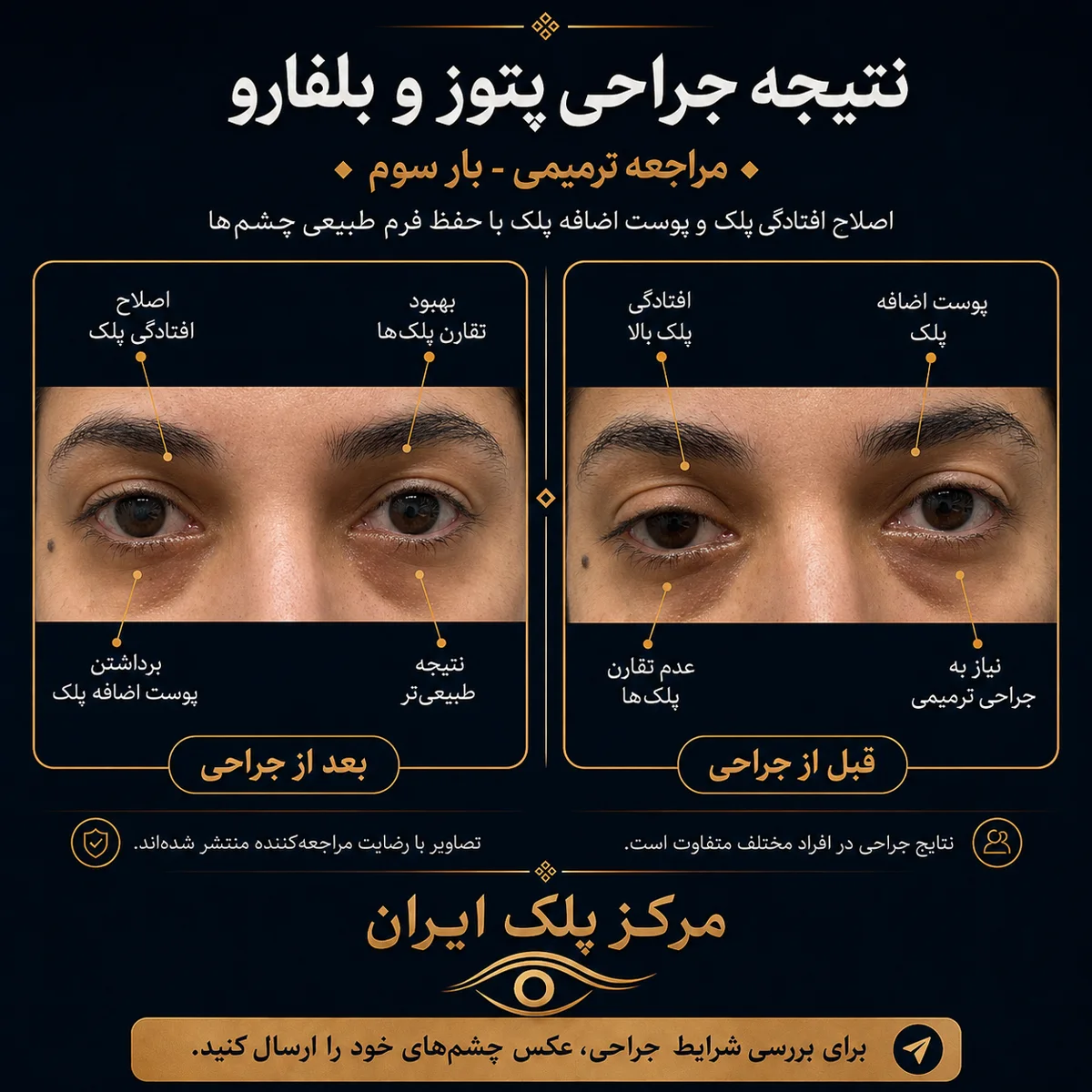 کیس ترمیمی پتوز؛ مقایسه قبل و بعد در نگاه روبه‌رو