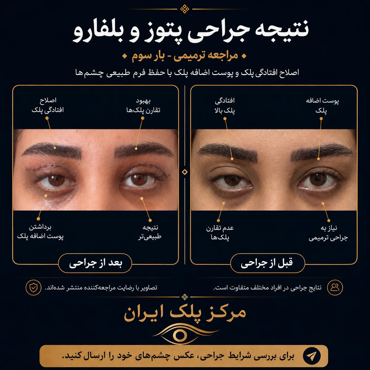 کیس ترمیمی پتوز و بلفارو؛ بهبود تقارن نگاه روبه‌رو